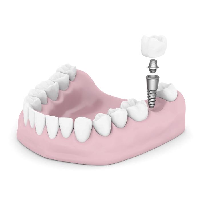 DentalImplantIllustration