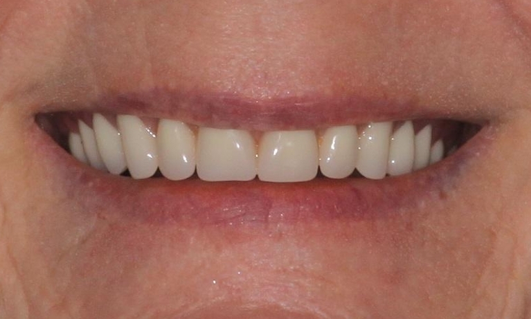Dentures-After-Image