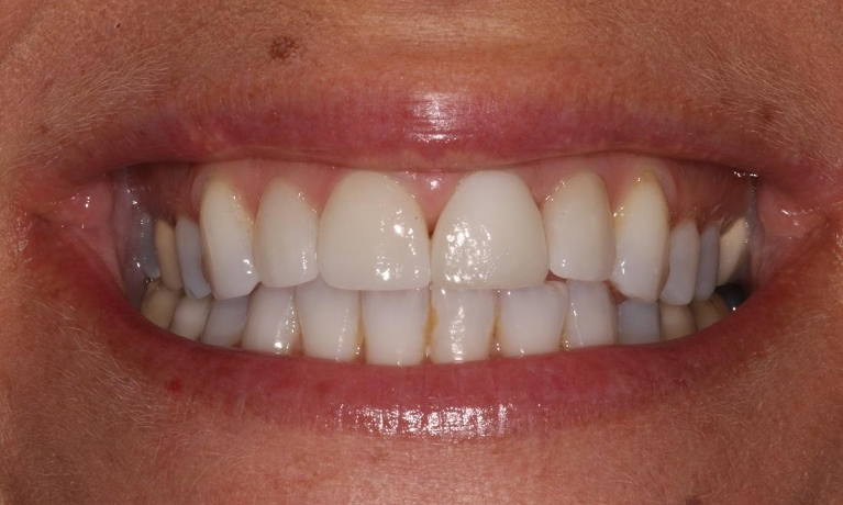 Veneers-After-Image