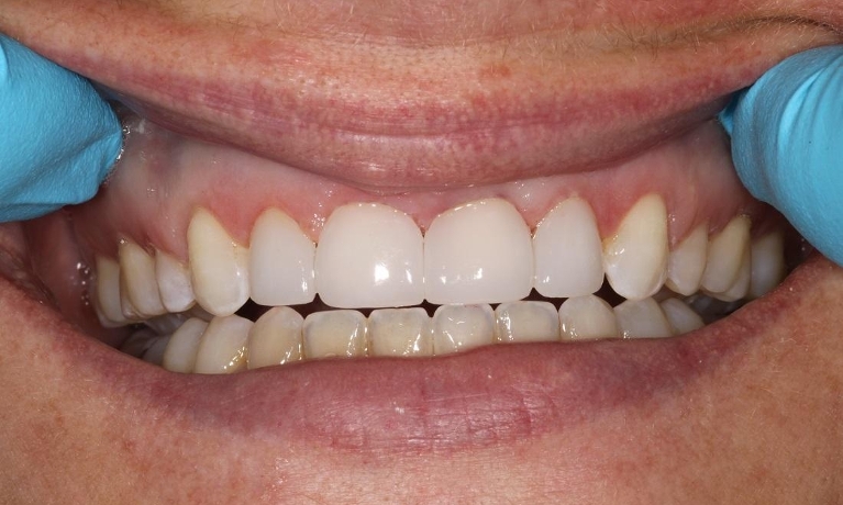 Veneers-After-Image