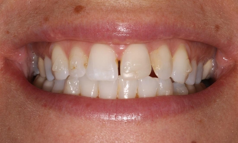 Veneers-Before-Image