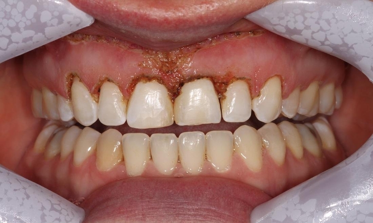 Veneers-Before-Image