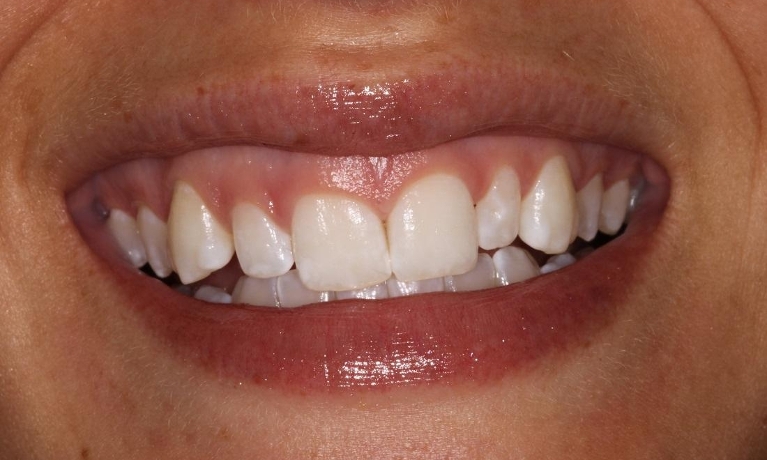 Veneers-and-Gingivectomy-Before-Image